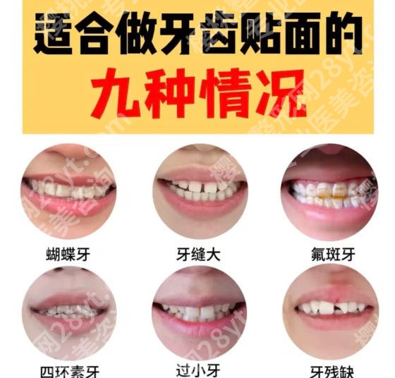 北京大学深圳医院牙齿贴面技术如何?2026收费细节展示!点击预览