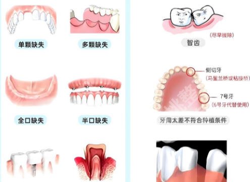 江门中心医院有种牙吗?术前检查和医生选择指南来啦!