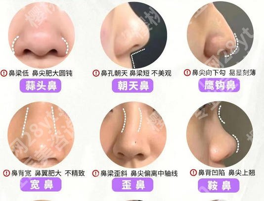 上海九院鼻修复专家排名榜单一览!祝联、钱云良、袁捷技术口碑好!