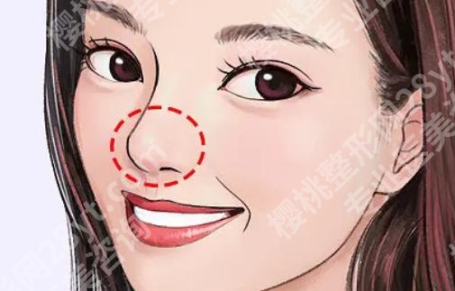 成都来瑞拉整形医院做鼻子好吗？真实案例分享！价格预览！