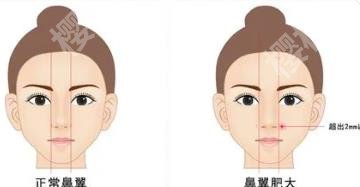 缩小鼻翼多少钱？能维持多久？术后注意事项介绍！