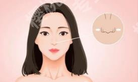 缩小鼻翼多少钱？能维持多久？术后注意事项介绍！