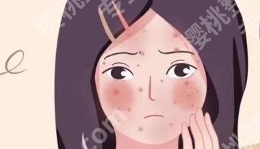 去痘印用什么好?多种方法介绍！一看便知！