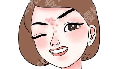 去痘印用什么好?多种方法介绍！一看便知！