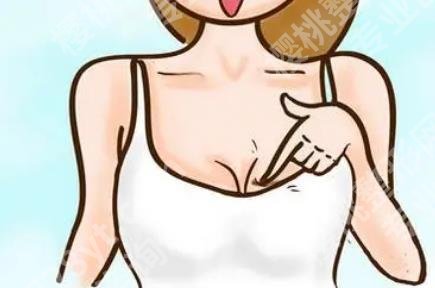 北京美莱隆胸全过程图片介绍！真实案例分享！术后很自然！