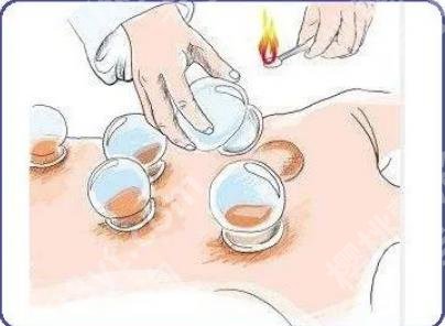 拔火罐能去风湿吗？科普知识介绍！一览便知！