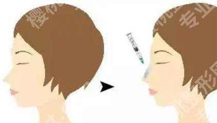 上海慕正医疗美容隆鼻多少钱?真实案例分享!术后很满意!