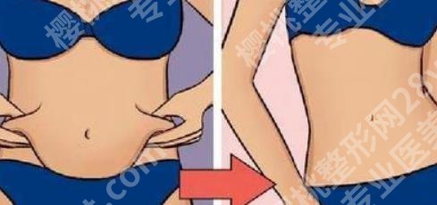 国内吸脂好还是去韩国吸脂好？两者区别介绍！各有特色！