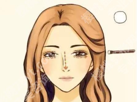 师丽丽内眼角修复案例公开！医院医生实力点评！一览便知！