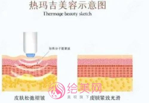 热玛吉果好吗？热玛吉项目副作用及风险介绍！戳进来看详情