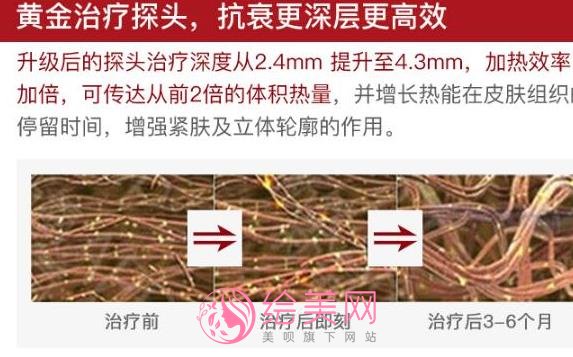 热玛吉果好吗？热玛吉项目副作用及风险介绍！戳进来看详情