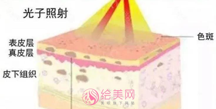 光子嫩肤和黑脸娃娃那种果好一些?医疗项目原理get!