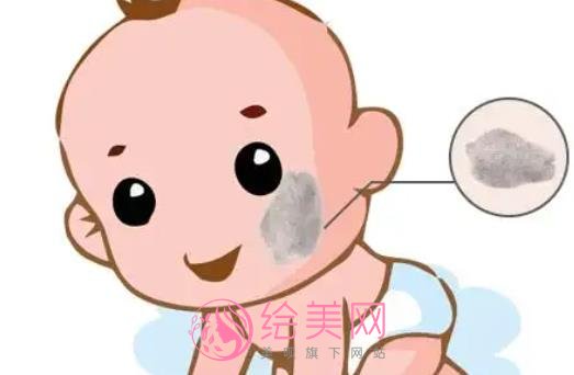 蒙古斑是什么?怎么去除呢?激光调节vs药物去除那种更可靠?