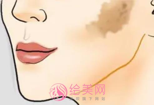 蒙古斑是什么?怎么去除呢?激光调节vs药物去除那种更可靠?