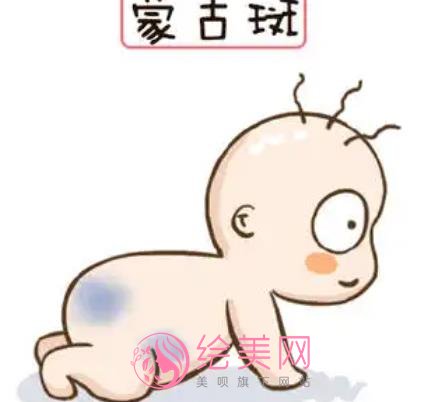 蒙古斑是什么?怎么去除呢?激光调节vs药物去除那种更可靠?