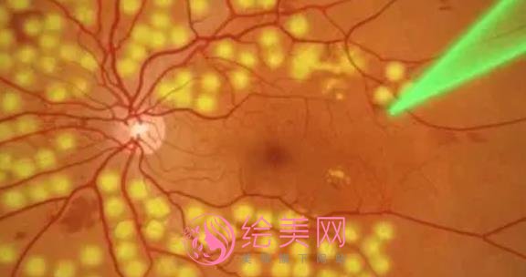 蒙古斑是什么?怎么去除呢?激光调节vs药物去除那种更可靠?