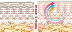 光子嫩肤对皮肤有伤害吗？做嫩肤项目前后有哪些需要注意的？