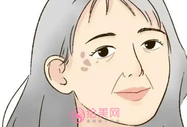 激光祛斑有果吗?祛斑原理是什么?戳进来看真人斑点去除案例吧