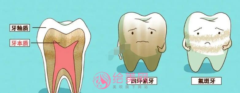 四环素牙如何美白？如何调节呢？术后注意事项有哪些？