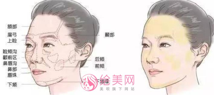 生物术除皱的果好不好?除皱案例对比图分享!