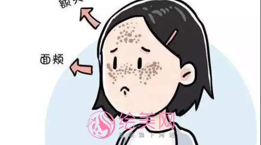 激光去黄褐斑会反弹吗？激光调节原理get！术后要注意什么？