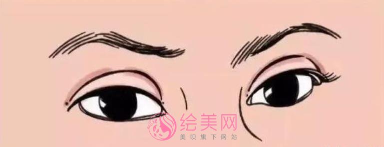 生物焊接双眼皮多少钱？价格影响因素有哪些？做双眼皮有什么需要注意的