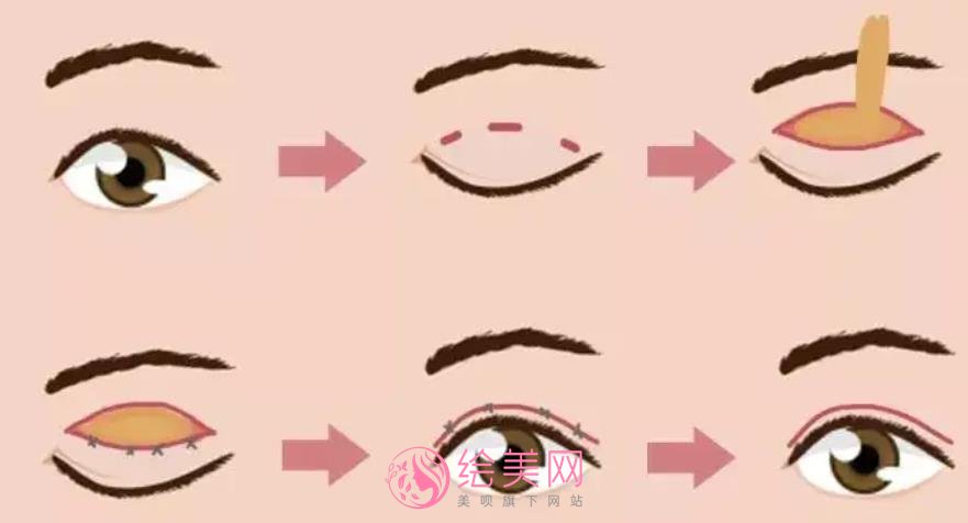生物焊接双眼皮多少钱？价格影响因素有哪些？做双眼皮有什么需要注意的