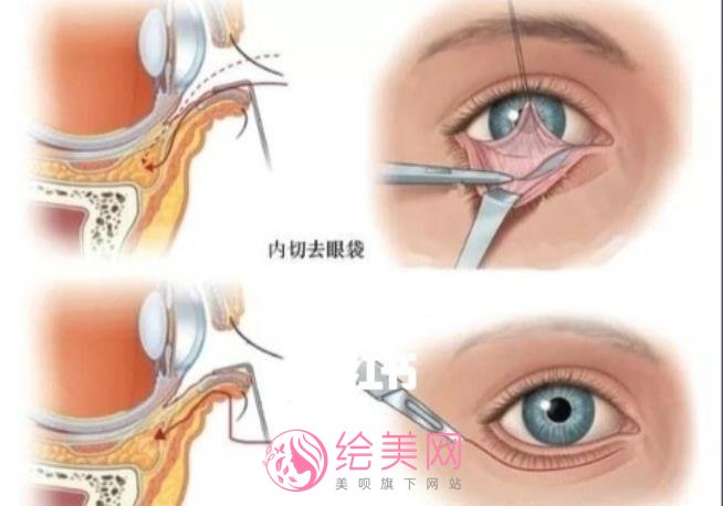 内切祛眼袋方法果好不好?有真人做眼袋去除术后60天果反馈哦!