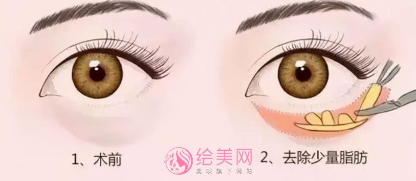 内切祛眼袋方法果好不好?有真人做眼袋去除术后60天果反馈哦!