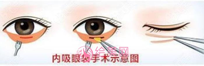 内切祛眼袋方法果好不好?有真人做眼袋去除术后60天果反馈哦!