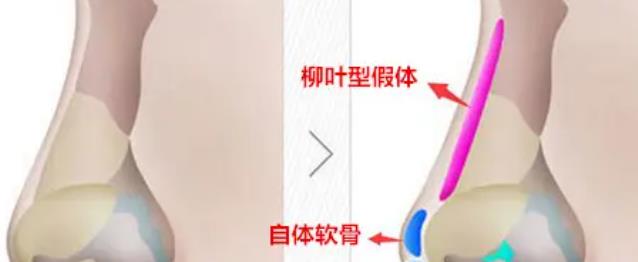 自体软骨隆鼻吗？隆鼻的原理是什么？手术前后注意事项有哪些？