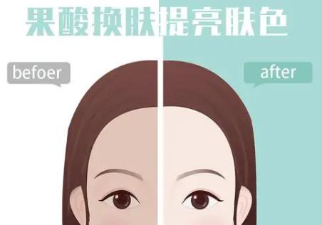 做几次果酸才祛痘印？原理是什么？有哪些需要注意的？