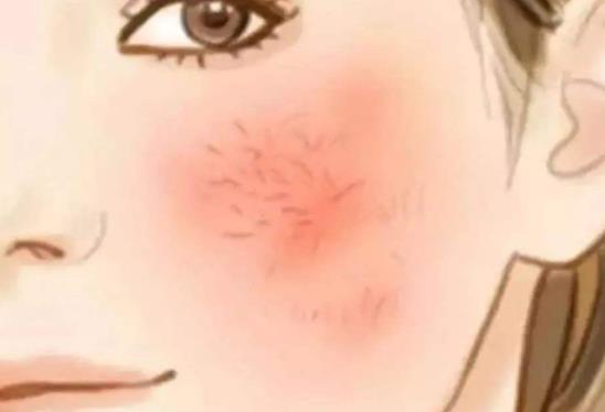 调节脸部红血丝的方法有哪些？激光调节vs光子嫩肤那种果好些？