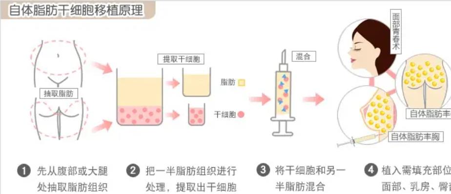 自体脂肪丰胸的果好不好？真人案例分享！