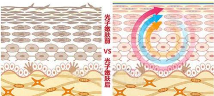 飞顿光子嫩肤的原理是什么?果好吗?有真人案例分享!