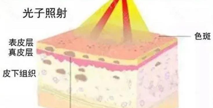 飞顿光子嫩肤的原理是什么?果好吗?有真人案例分享!
