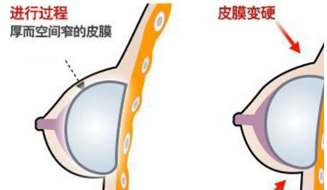 做假体隆胸手术吗?术后常见的危害并发症有哪些?