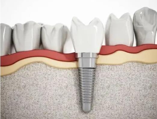 种植牙的利与弊分析|做牙齿种植之后对于口腔有哪些危害？