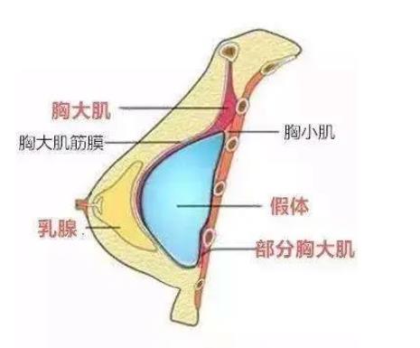 自体脂肪注射式隆胸过程介绍!有真人做胸部整形后60天果反馈哦!