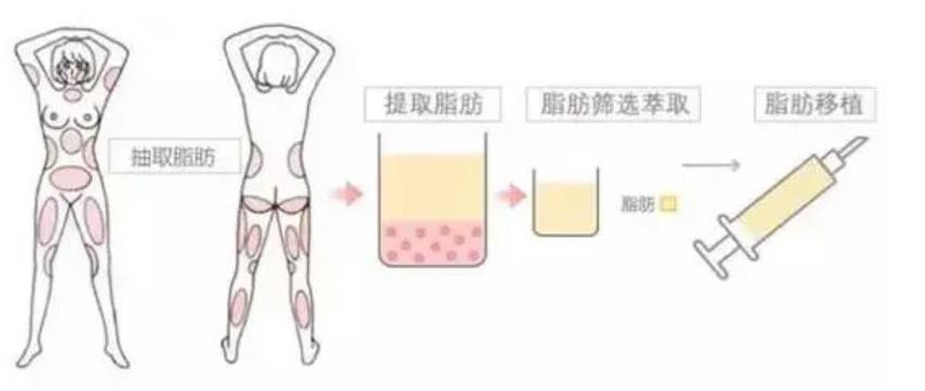 自体脂肪注射式隆胸过程介绍!有真人做胸部整形后60天果反馈哦!