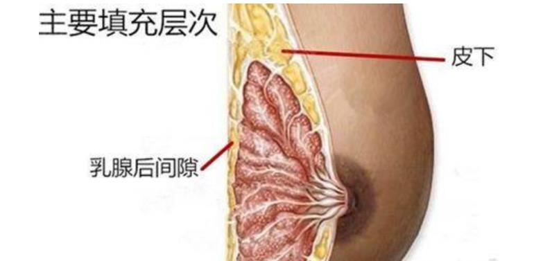自体脂肪注射式隆胸过程介绍!有真人做胸部整形后60天果反馈哦!