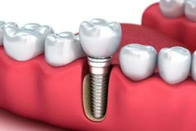 种植牙的利与弊分析|做牙齿种植之后对于口腔有哪些危害？