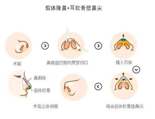 自体耳软骨隆鼻好吗？耳软骨材料隆鼻优势有哪些？术后会有哪些危害？