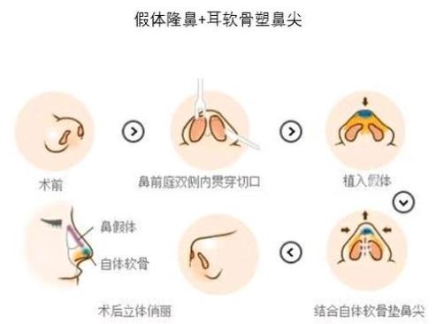 自体耳软骨隆鼻好吗？耳软骨材料隆鼻优势有哪些？术后会有哪些危害？