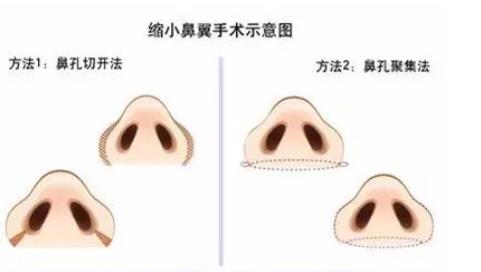 鼻翼缩小前后对比照曝光!个人记录手术前后全过程分享!