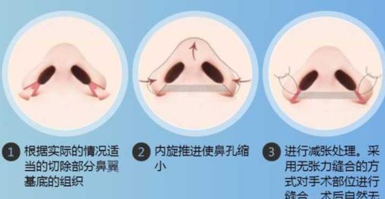 鼻翼缩小前后对比照曝光!个人记录手术前后全过程分享!