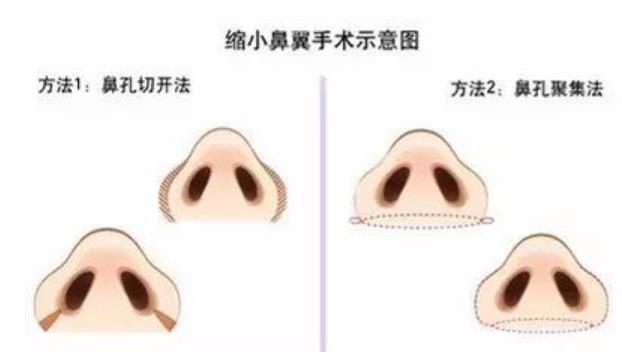 鼻翼缩小前后对比照曝光!个人记录手术前后全过程分享!