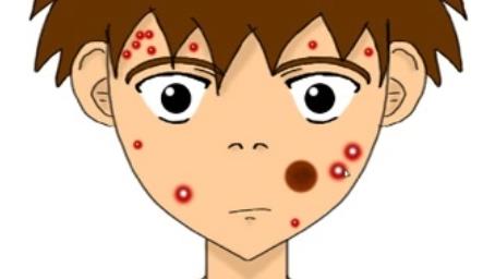 点阵激光3次痘坑全没有了吗？费用需要多少？护理方式介绍！