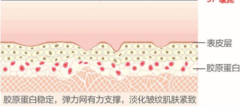 瞬间除皱术：热玛吉的果好不好？需要做几次才能去除皱纹？