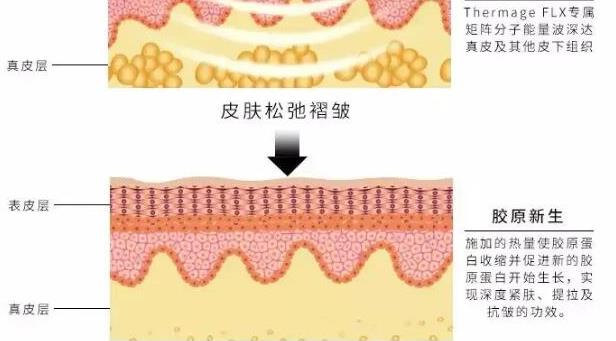 瞬间除皱术：热玛吉的果好不好？需要做几次才能去除皱纹？